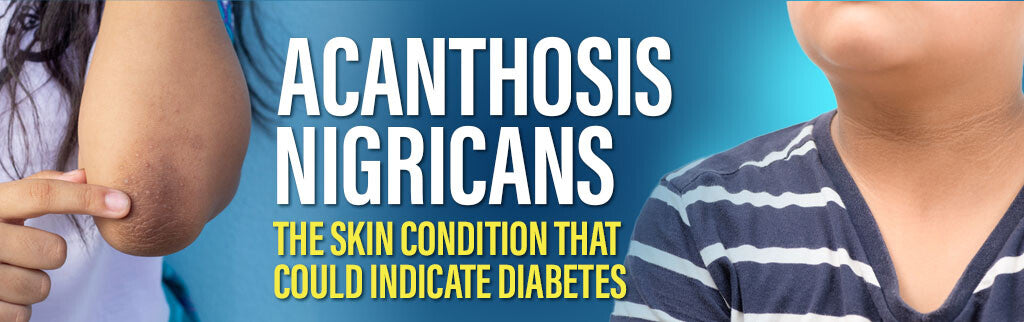 Acanthosis Nigricans and Its Connection to Diabetes